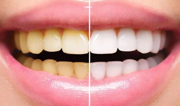 estecica dental clareamento brasilia ceilandia estecica dental clareamento brasilia ceilandia