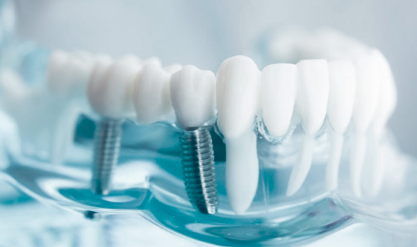 implante-dentario-domsorriso implante-dentario-domsorriso