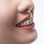 Teeth with braces